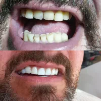 جشنواره خدمات زیبایی دندان با افر 60٪ از دست ندید|خدمات آرایشگری و زیبایی|بابل, |دیوار