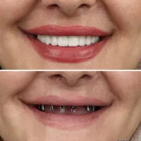 ایمپلنت با اقساط بلند مدت در تبریز|خدمات آرایشگری و زیبایی|اهر, |دیوار