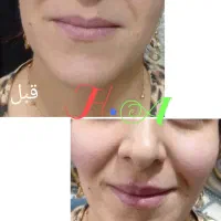 جشنواره ژل و بوتاکس درکلینیک پوست ومو|خدمات آرایشگری و زیبایی|شاهینشهر, فردوسی|دیوار