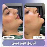 ژل لب بوتاکس زیر بغل فیلر بادی لیفت شقیقه نخ لیفت|خدمات آرایشگری و زیبایی|اصفهان, فیض|دیوار