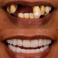 دندانپزشک اقساط کامپوزیت لمینیت لب شیشه ای بلیچینگ|خدمات آرایشگری و زیبایی|مشهد, سجاد شهر|دیوار