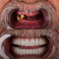 مرکز تخصصی دندانپزشکی ایمپلنت آلمانی(اقساط ۱۲ماهه)|خدمات آرایشگری و زیبایی|تبریز, |دیوار