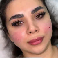 ژل . بوتاکس . فیلر .مزو