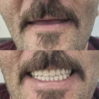 دندان مصنوعی خارجی ،ژله ای بافکی۶ میلیون ضمانت دار