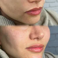 تزریق ژل وبوتاکس(سی سی ۵۰۰)ارایش دائم صورت،پیرسینگ