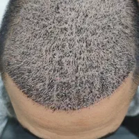 جشنواره کاشت مو و ابرو|خدمات آرایشگری و زیبایی|تهران, افسریه شمالی|دیوار