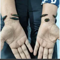 حجامت وزالو درمانی