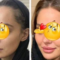 چاقی صورت تپلی صورت دائمی جوانه گندم