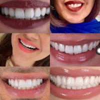 شرایط اقس*اط دندانپزشکی بدون بهره