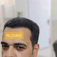 کاشت مو و ریش با نتیجه طبیعی، خط رویش حرفه‌ای