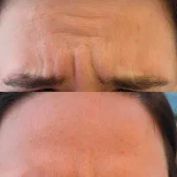 آنزم و مزو تراپی و فیلر و بوتاکس|خدمات آرایشگری و زیبایی|قرچک, مهدیه|دیوار