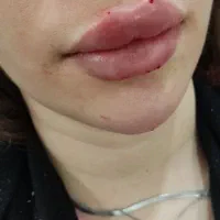 ژل وبوتاکس زابل