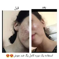 پاکسازی صورت با قیمت مناسب فقط فقط بانوان|آرایشی، بهداشتی، درمانی|مشگین شهر, |دیوار