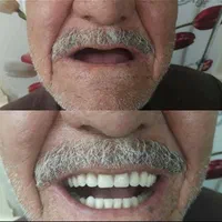 دندانسازی دندان سازی دندان مصنوعی پروتز|خدمات آرایشگری و زیبایی|مشهد, ولیعصر (شهرک غرب)|دیوار