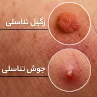 رفع زگیل تناسلی یا ویروسhpv خانما و آقایان