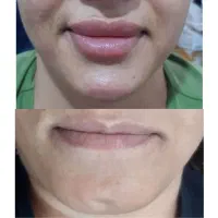 خدمات ژل و بوتاکس و مزو