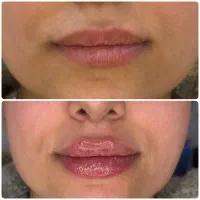 زیبایی فیلر بوتاکس