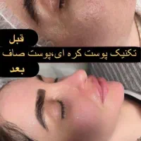 لیزرموزائد سوپرانوتیتانیوم آلما اصلی ۴۹۰تومن|خدمات آرایشگری و زیبایی|گرگان, |دیوار