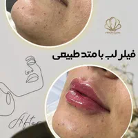 *جشنوااره خدمات تخصصی لیزر ، تزریق فیلر و بوتاکس|خدمات آرایشگری و زیبایی|اصفهان, هزارجریب|دیوار