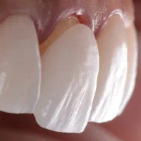 لمینت.کامپوزیت.عصبکشی