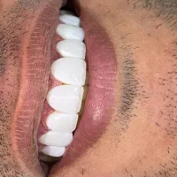 آموزشگاه دندانپزشکی دستیار دندانپزشکی کامپوزیت