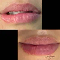 اموزش ژل و بوتاکس