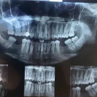 دندانپزشکی .عصب کشی ترمیم .پرکردن جراحی‌‌اطفال