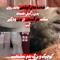 درمان زگیل و تبخال تناسلی