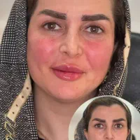 آف 40 پی ارپی مو اقایان ژل بوتاکس مزوتراپی انزیم