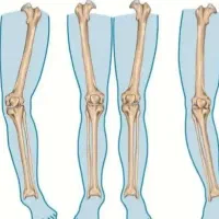 مرکز ارتوپدی اصلاح غیرجراحی انحرافات زانو|خدمات آرایشگری و زیبایی|همدان, |دیوار