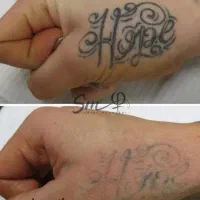 پاک کردن انواع تتو و خالکوبی های قدیمی