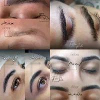 جذب مدل ریموو تتو صورت با شرایط ویژه