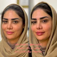 تزریق ژل و بوتاکس و لیزر در مطمئن ترین کلینیک مشهد|خدمات آرایشگری و زیبایی|مشهد, احمدآباد|دیوار
