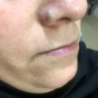 حذف انواع خال (گوشتی،سطحی،زیگیل)|خدمات آرایشگری و زیبایی|کاشان, فاز ۲ ناجی آباد|دیوار