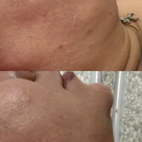 جوانسازی و لیفت صورت و رفع غبغب
