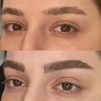 تخفیف ویژه میکروبلیدینگ،فیبروز به مدت محدود )