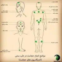 حجامت،بادکش