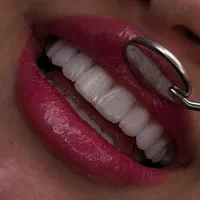 کامپوزیت دندان هر فک فقط ۱۰ میلیون تومان