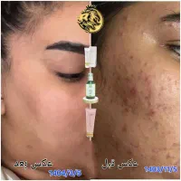 مشاوره و تست رایگان ،پاکسازی پوست۵۰٪کلینیک بزرگمهر