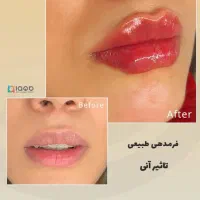 بلفاروبلاستی/کاشت مو/کاشت ابرو/کاشت ریش/عمل بینی|خدمات آرایشگری و زیبایی|همدان, |دیوار