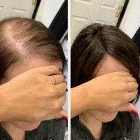 کف سرت جنگل میشه بمب قطع ریزش مو