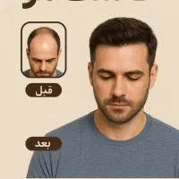 کاشت مو با شرایط ویژه