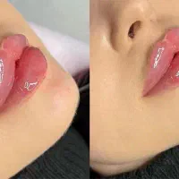 تخفیف تزریق ژل و مزوژل های جوانساز