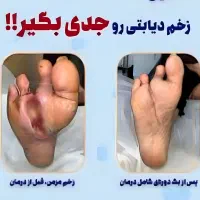 بهبودی کامل دیابت و پایین آمدن قند خون