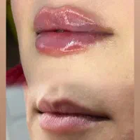 تزریق ژل لب،بوتاکس،مزو تراپی،هایفو تراپی،لیزر|خدمات آرایشگری و زیبایی|فردیس, شهرک ارم|دیوار