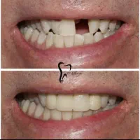 وام دندانپزشکی ایمپلنت|خدمات آرایشگری و زیبایی|رباط‌کریم, رباط‌کریم|دیوار