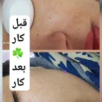 سفید سازی بکینی، جوانسازی پوست پیلینگ(کربن تراپی)|خدمات آرایشگری و زیبایی|مشهد, فرهنگیان (شهرک غرب)|دیوار