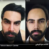 عمل بینی/ کاشت ابرو و مو / بلفارو /تزریق چربی