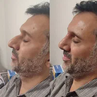 تزریق ژل بوتاکس فیلر تخفیف ویژه|خدمات آرایشگری و زیبایی|تهران, سبلان (لشگر)|دیوار