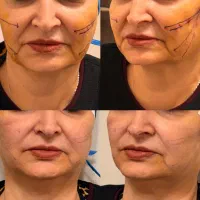 نخ لیفت،نخ کلاژن ساز،مزو و رفع غبغب ،کیلینیک صداقت